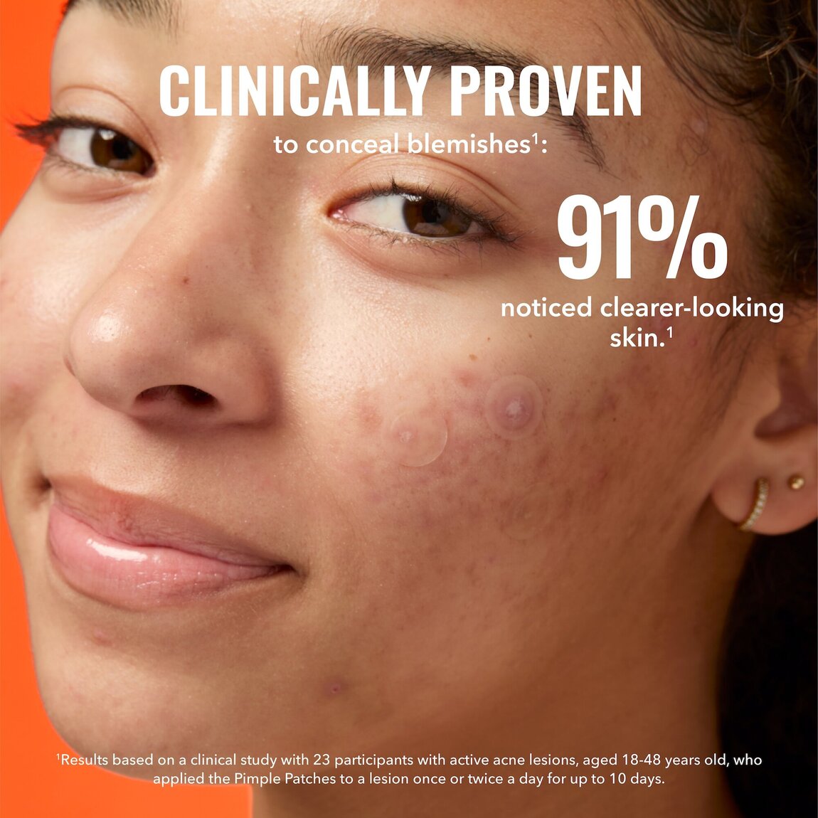 pimple-patches-n0 zb_p.jpg