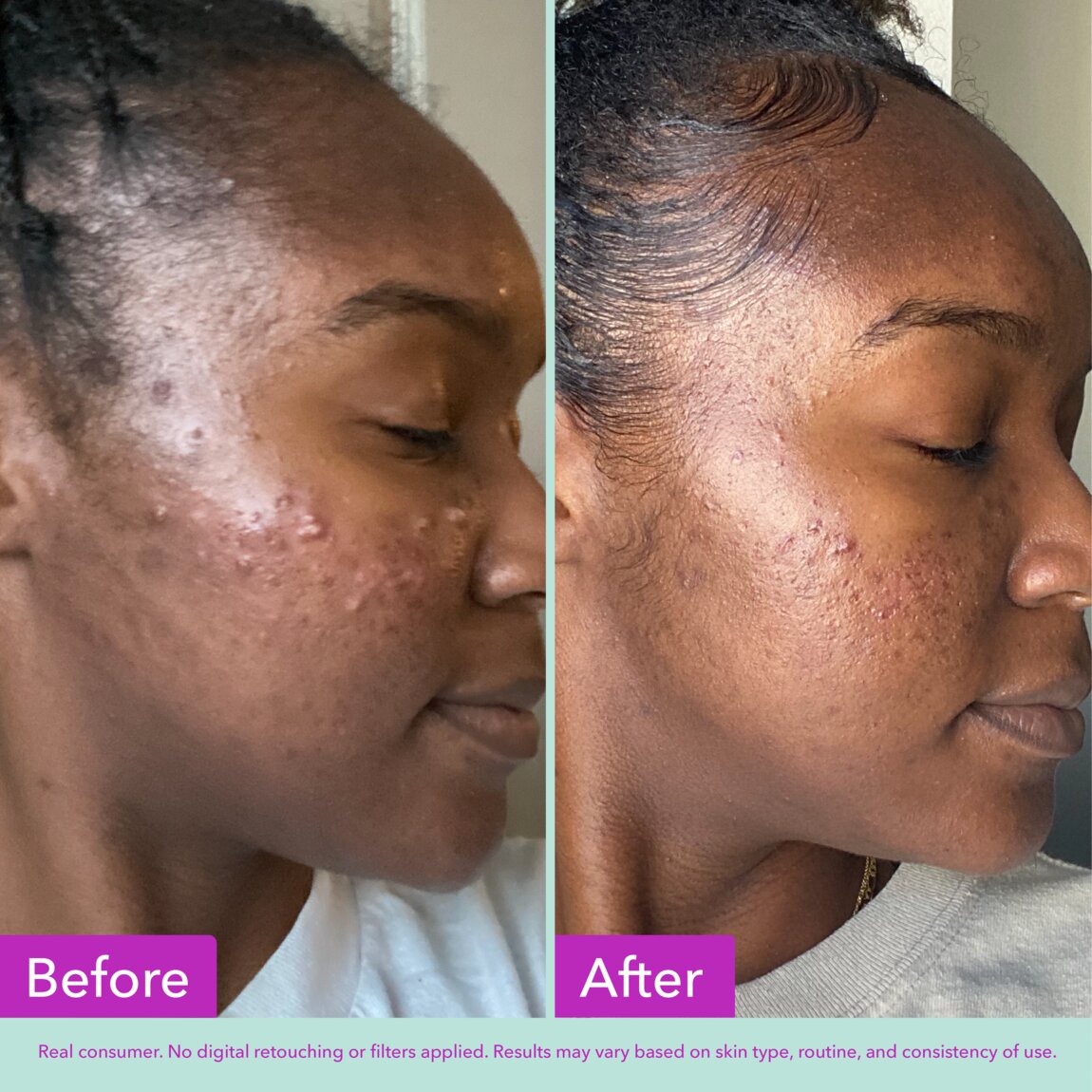 acne-foaming-cleanser-g3 zb_p.jpg